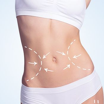 Abdominoplasty