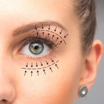 Blepharoplasty